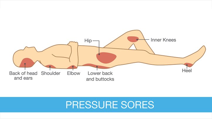 Image result for bed sores