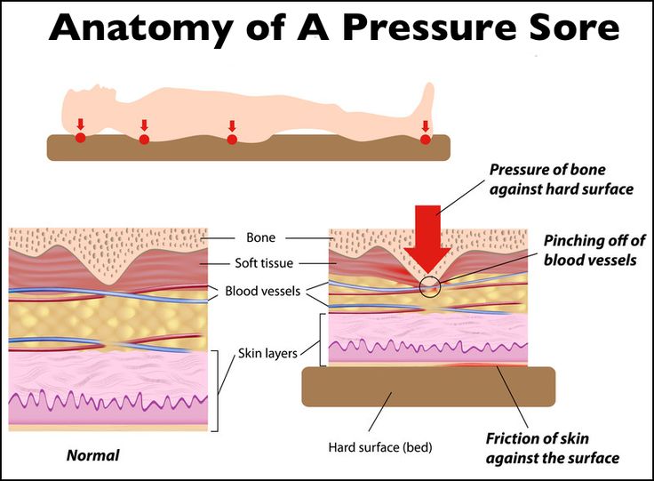 Image result for bed sores