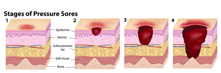 Image result for bed sores